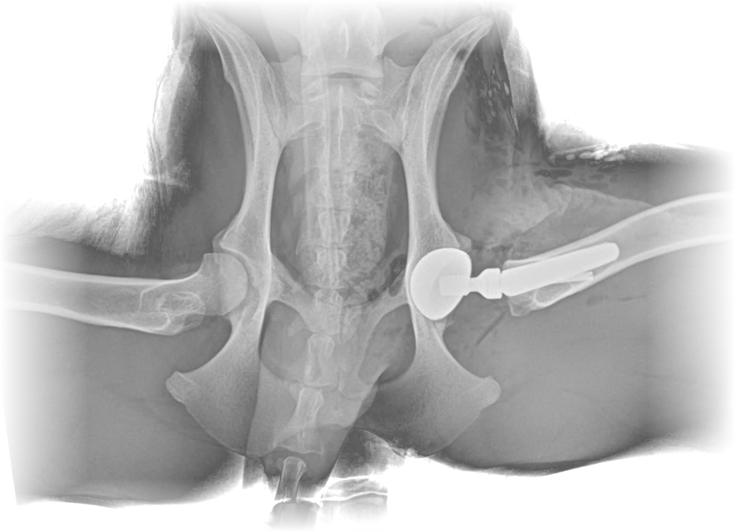 Radiografía posoperatoria de reemplazo total de cadera