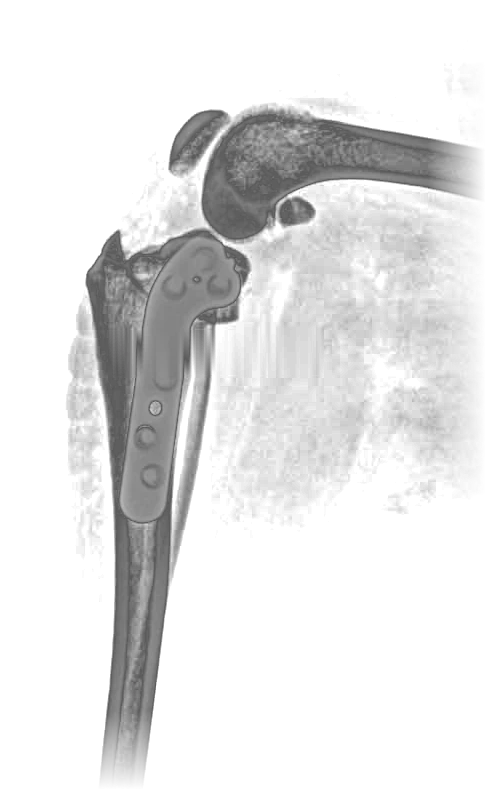 Radiografía posquirúrgica de tibia con placa 2,7 mm